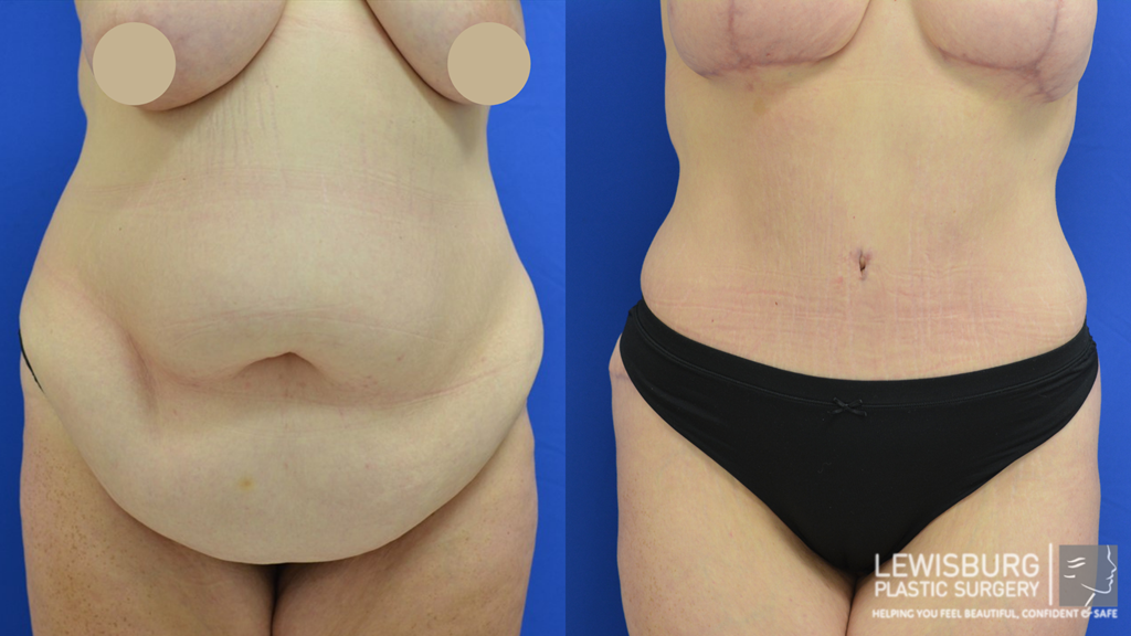 Cost of Tummy Tuck - Surgery, Benefits, Results, etc.